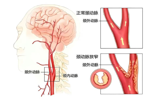颈动脉外膜剥脱术